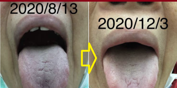 (7)舌質瘀暗改善=深層血液循環改善=細動脈硬化及微血管梗塞改善