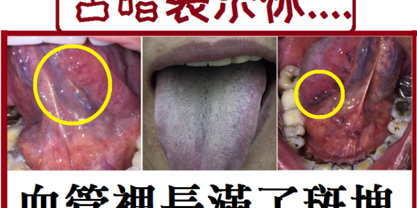 (6)舌暗藏中風.心肌梗塞危機