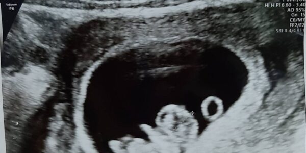 葳儀(化名)2個卵巢都有巧克力囊腫,最大的1顆有8cm,經痛…有機會懷孕嗎?